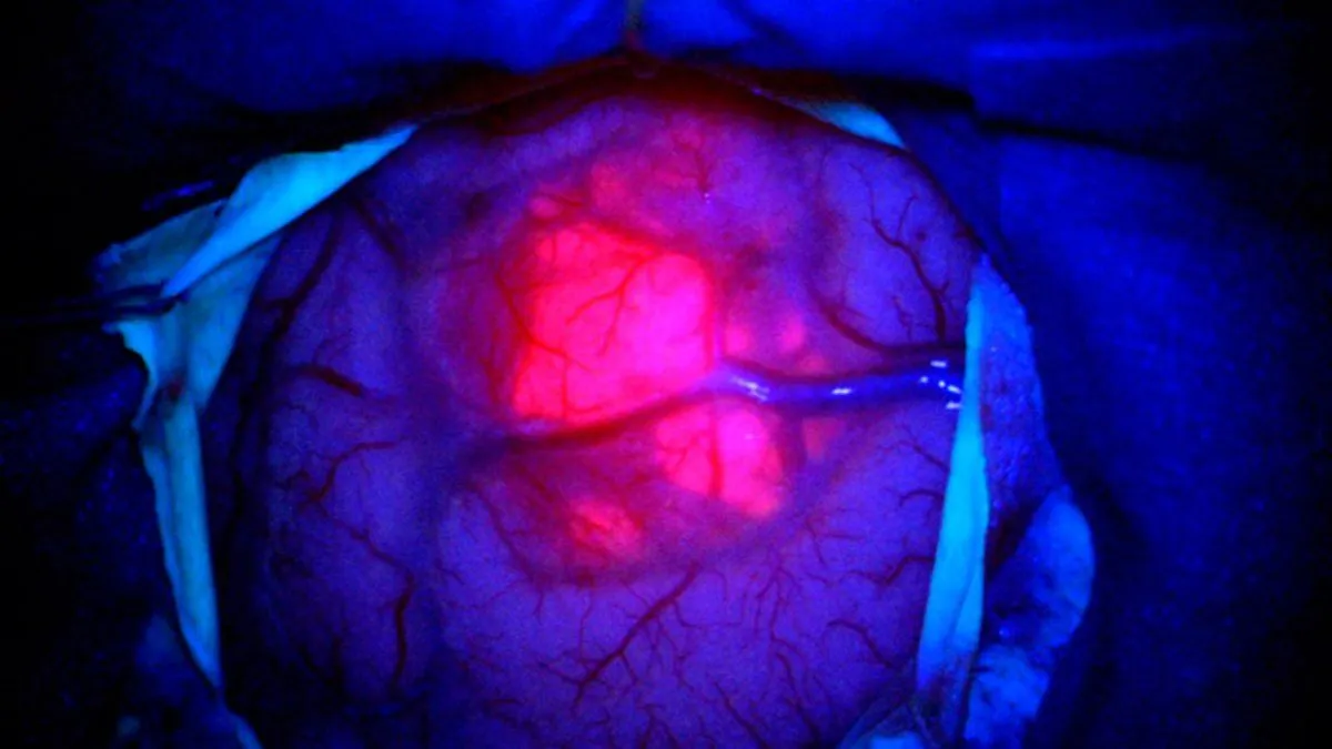 Neurocirurgia mais precisa em Balneário Camboriú